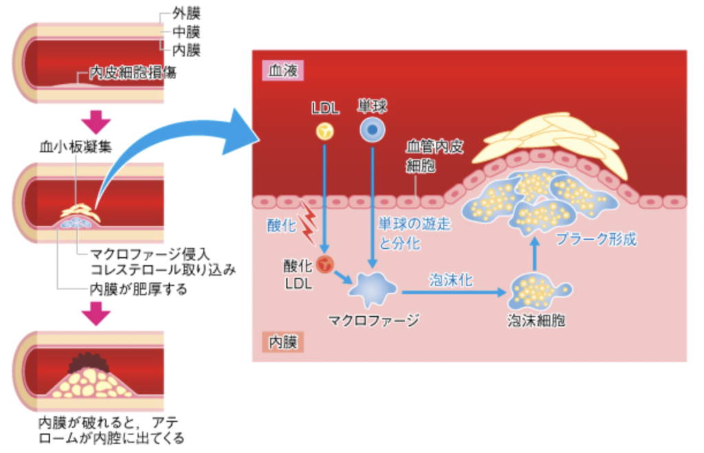 悪玉コレステロールが動脈硬化の原因になる理由 | 森嶋クリニック